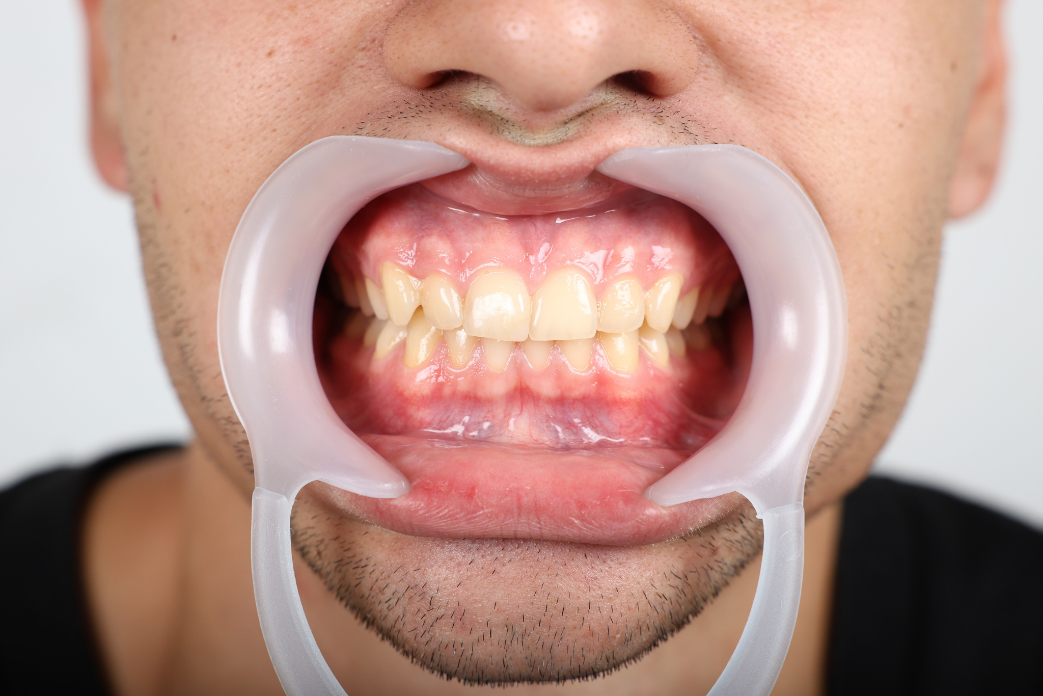 Before E-max Veneer Treatment